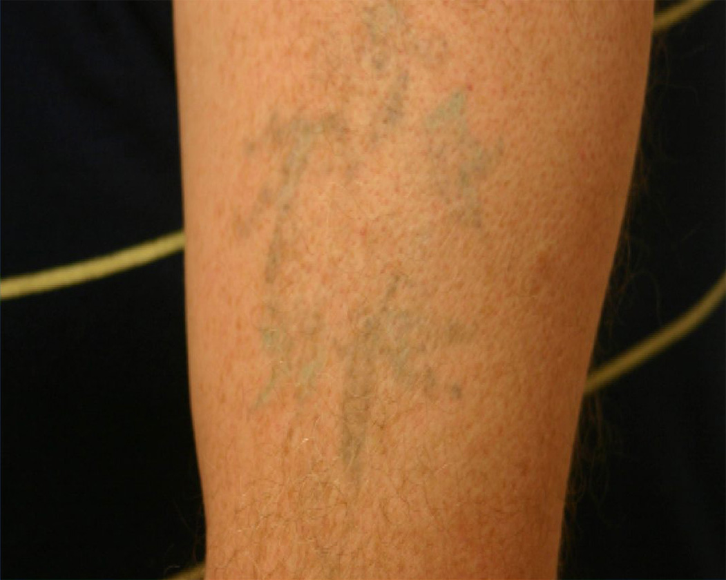 Tattoo after laser removal