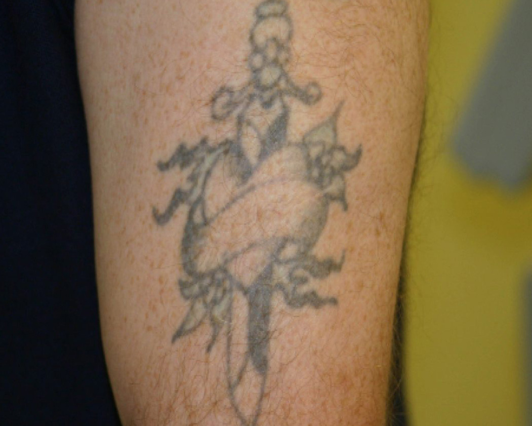 Tattoo before laser removal